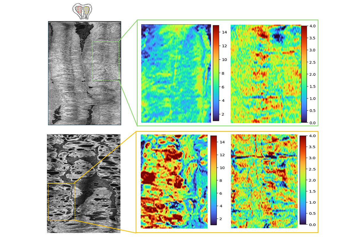 Examples of OCT C-scans from normal endometrium (top row) and high-risk precancerous endometrium (bottom row). The images show the OCT intensity C-scan (left), optical extinction coefficient map (middle), and scatterer shape factor map (right) from the highlighted regions. The high-risk precancerous endometrium displayed more complex low-intensity structures, reflecting irregular and dilated glands of varying sizes. In contrast to the normal endometrium, the precancerous tissue demonstrated markedly greater architectural irregularity and heterogeneity in the optical scattering maps. (Credit: Zhu Lab)  